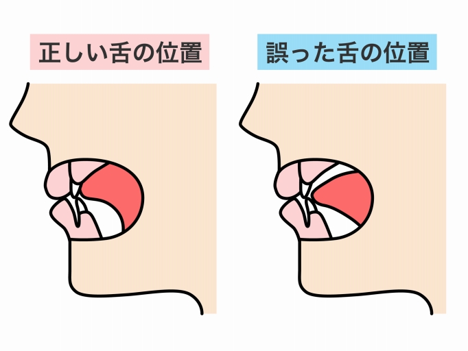 正常な舌の位置・低位舌の位置