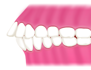 前歯が出ている「出っ歯」（上顎前突）