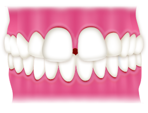 歯と歯の間にすき間がある「すきっ歯」（空隙歯列）